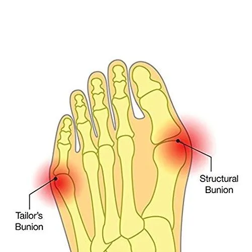 Bunion Gel Pads - Big Toe Straightener ~ Pain Relief!